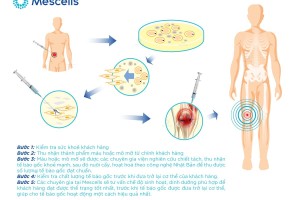 Tế bào gốc tự thân là gì? Ứng dụng tiêm tế bào gốc tự thân trong điều trị bệnh lý