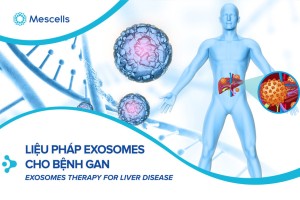Tầm quan trọng của exosome trong sự phát triển và điều trị ung thư biểu mô tế bào gan