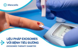 Exosomes tế bào gốc trung mô có thể là một chiến lược mới để điều trị các biến chứng của bệnh tiểu đường