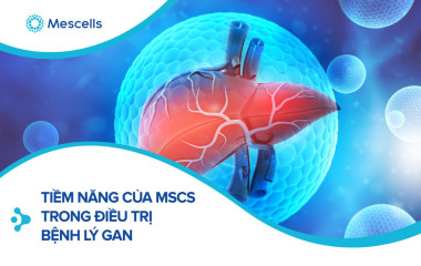 A novel stem cell therapy for hepatitis B virus-related acute-on-chronic liver failure