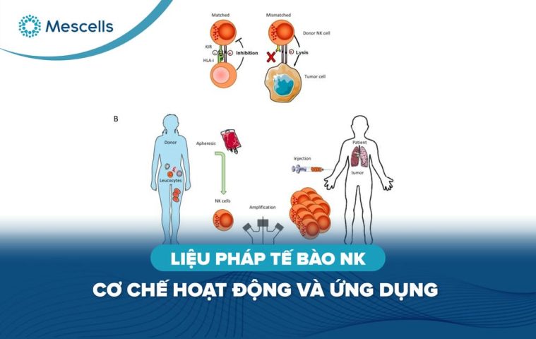 Liệu pháp tế bào nk-01