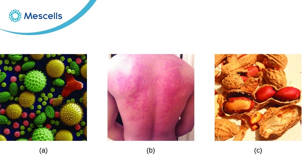 Phản ứng quá mẫn-05