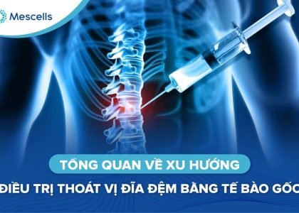 Điều trị thoát vị đĩa đệm bằng tế bào gốc