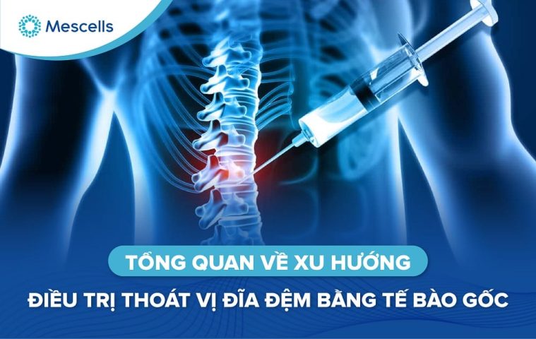Điều trị thoát vị đĩa đệm bằng tế bào gốc