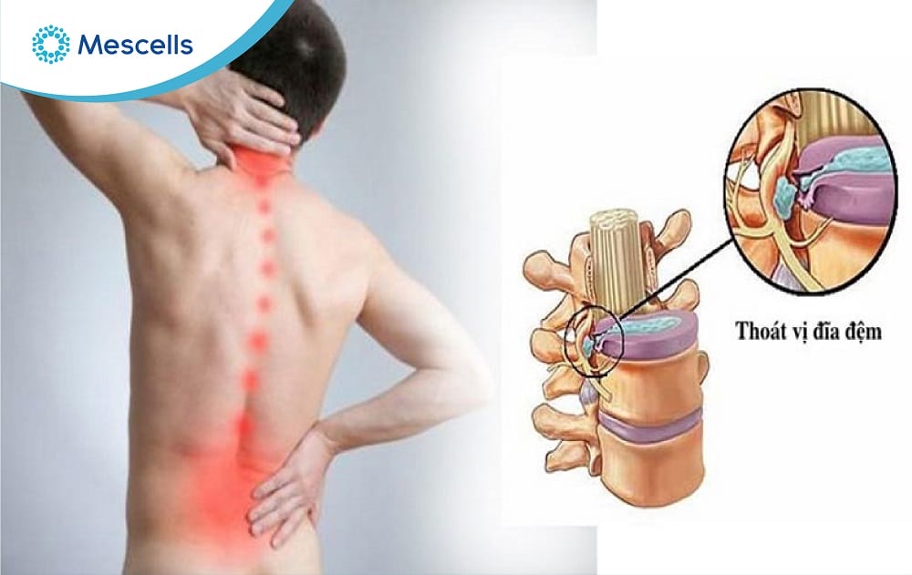 Điều trị thoát vị đĩa đệm bằng tế bào gốc