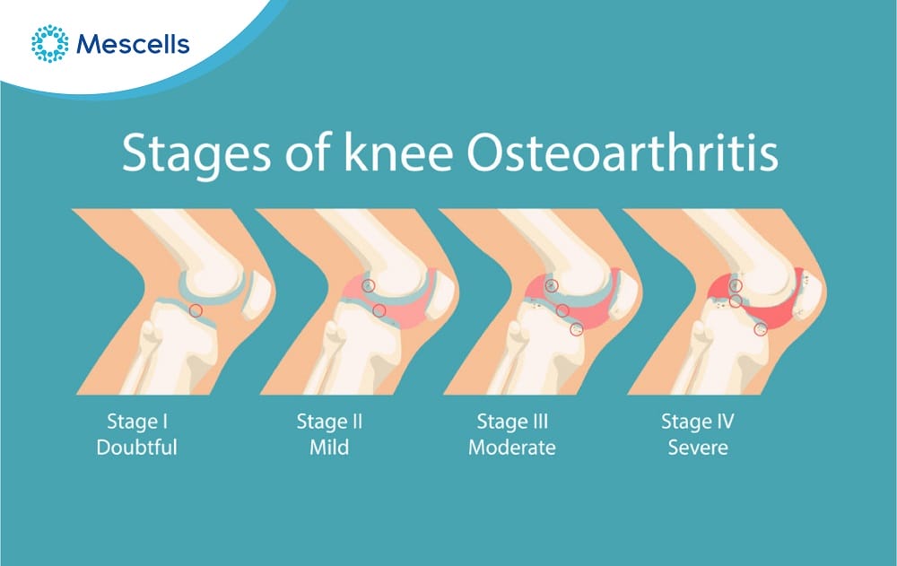 Tiềm năng điều trị thoái hóa khớp gối bằng tế bào gốc-02