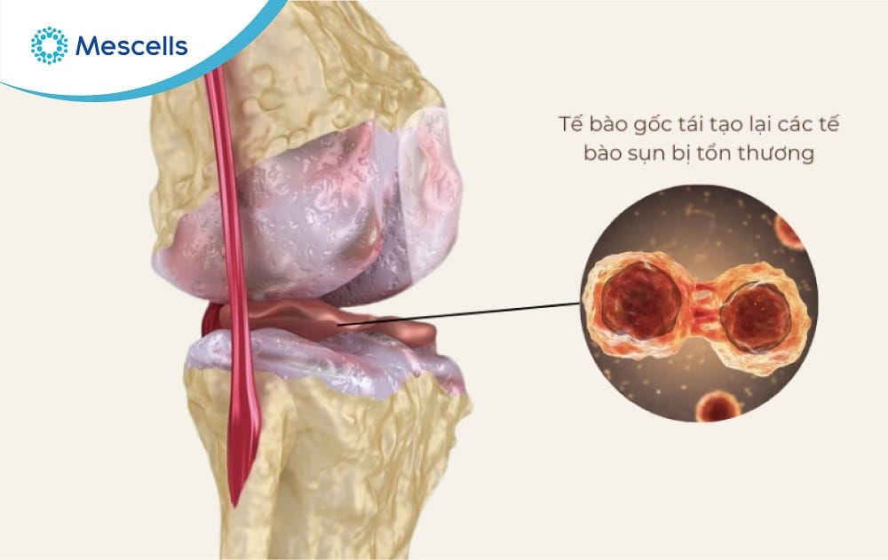 Tiềm năng điều trị thoái hóa khớp gối bằng tế bào gốc-04