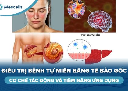 Điều trị bệnh tự miễn bằng tế bào gốc-01