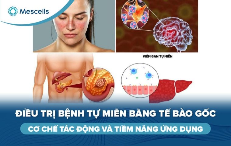 Điều trị bệnh tự miễn bằng tế bào gốc-01
