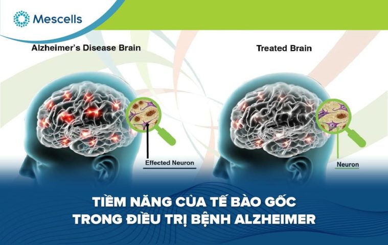 Tiềm năng của tế bào gốc trong điều trị bệnh Alzheimer-01