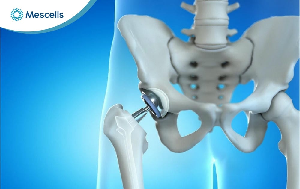Tiềm năng điều trị thoái hóa khớp háng bằng tế bào gốc-04