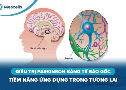 Điều trị Parkinson bằng tế bào gốc-01