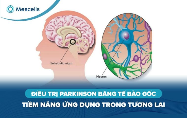 Điều trị Parkinson bằng tế bào gốc-01
