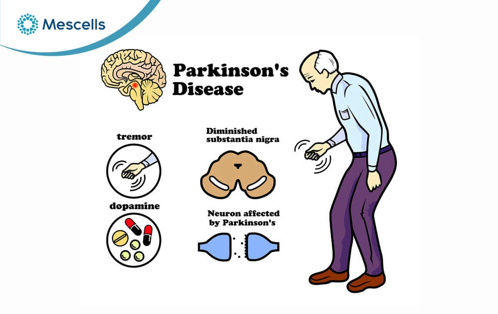 Điều trị Parkinson bằng tế bào gốc-02