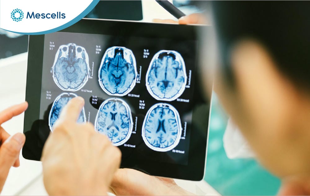Điều trị Parkinson bằng tế bào gốc-05