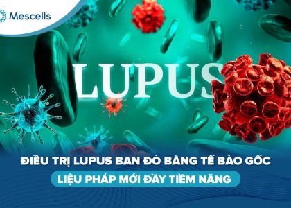 Điều trị lupus ban đỏ bằng tế bào gốc-01