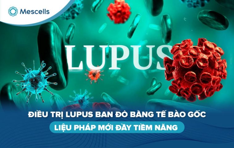 Điều trị lupus ban đỏ bằng tế bào gốc-01