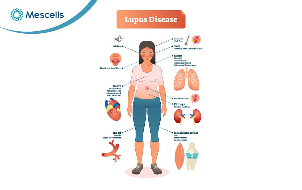 Điều trị lupus ban đỏ bằng tế bào gốc-02