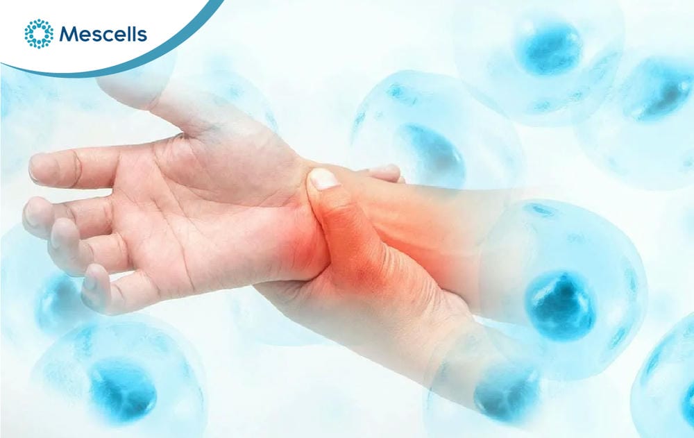 Điều trị lupus ban đỏ bằng tế bào gốc-04