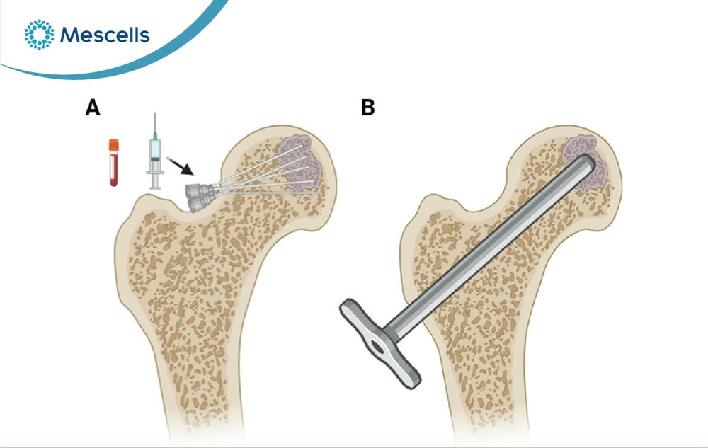 Tế bào gốc trong điều trị hoại tử chỏm xương đùi-05