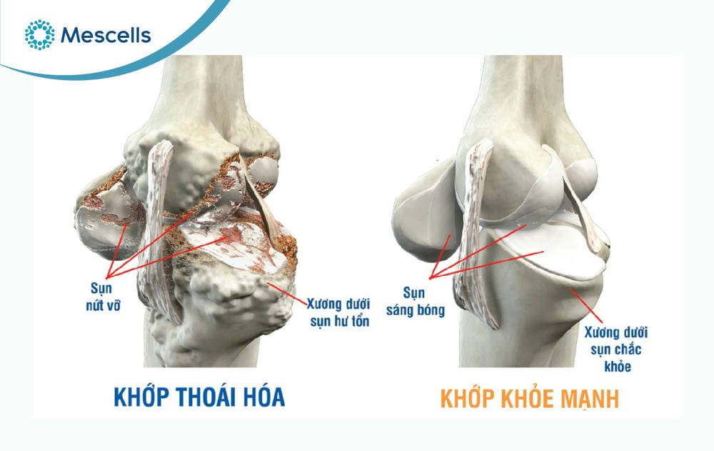 Điều trị thoái hóa khớp bằng tế bào gốc-02