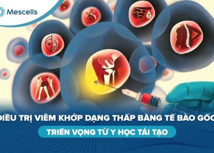 Điều trị viêm khớp dạng thấp bằng tế bào gốc-01