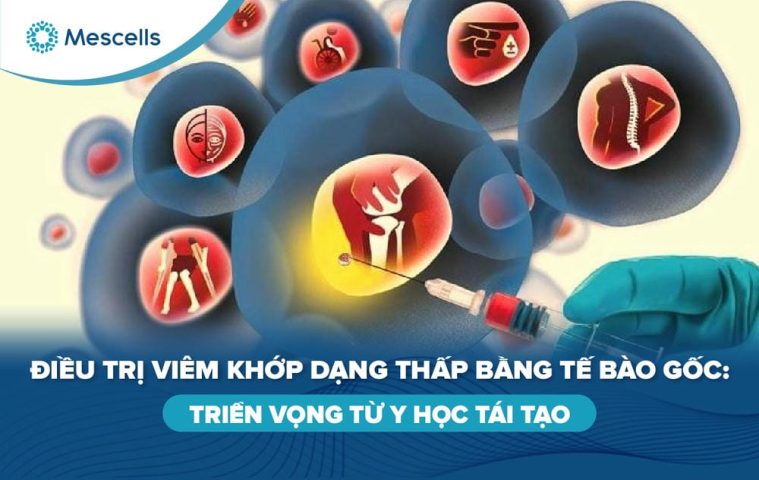 Điều trị viêm khớp dạng thấp bằng tế bào gốc-01