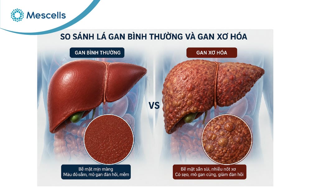 Điều trị xơ gan bằng tế bào gốc-02