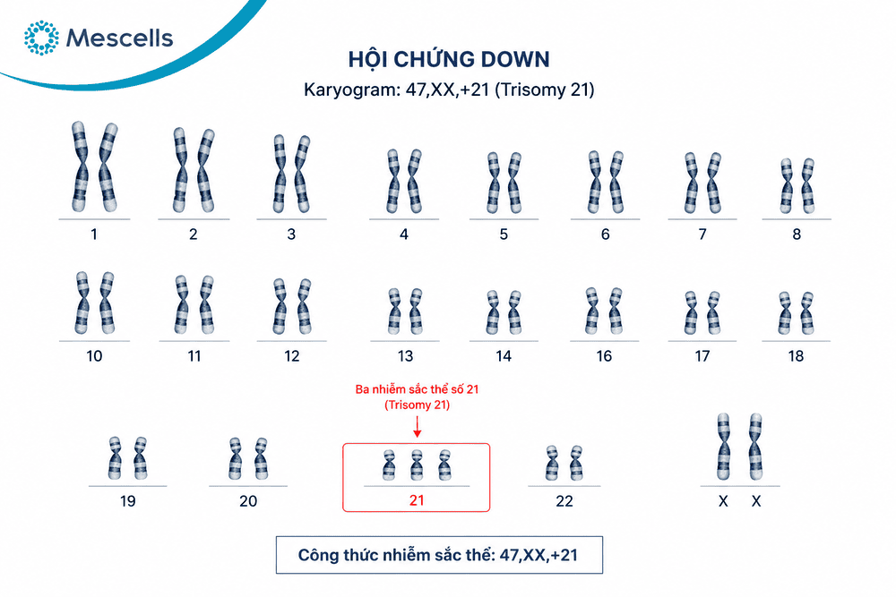 Karyotype ở người bệnh Down