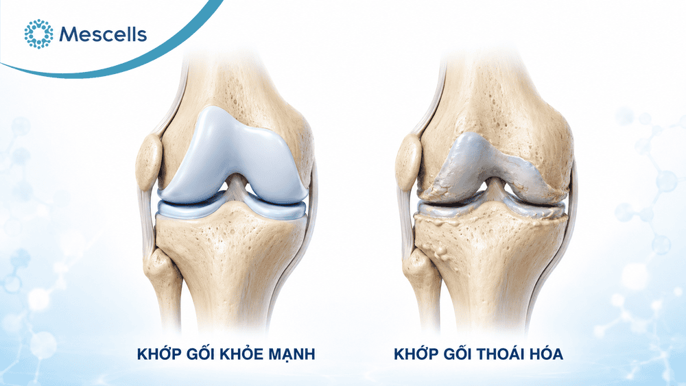 Tái tạo sụn khớp-02