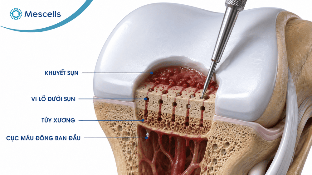 Tái tạo sụn khớp-06
