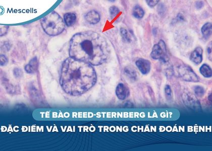 Tế bào Reed-Sternberg là gì-01