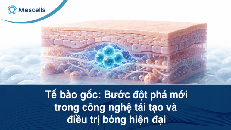 Tế bào gốc điều trị bỏng