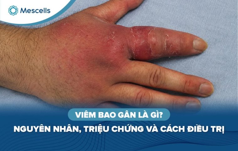 Viêm bao gân là gì Nguyên nhân, triệu chứng và cách điều trị-01