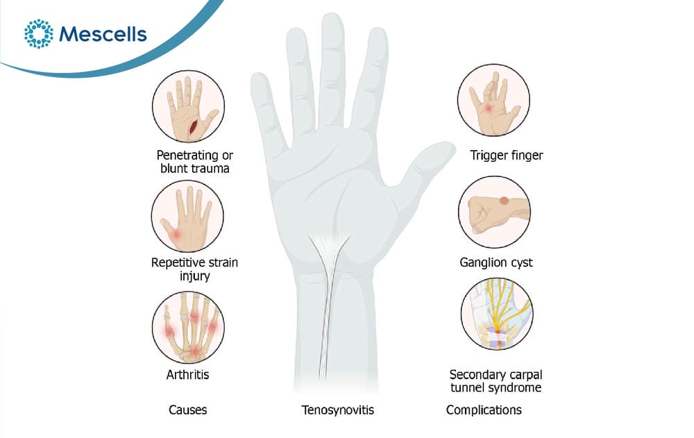 Viêm bao gân là gì Nguyên nhân, triệu chứng và cách điều trị-03