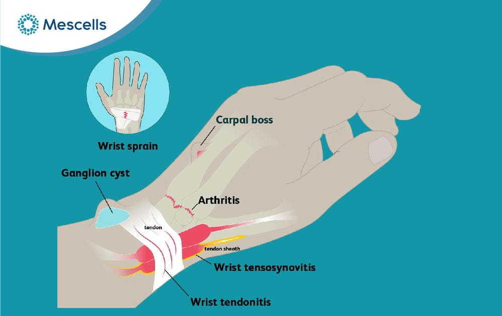 Viêm bao gân là gì Nguyên nhân, triệu chứng và cách điều trị-04