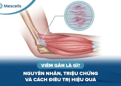 Viêm gân là gì-01