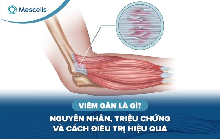 Viêm gân là gì-01